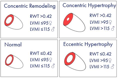 lv mass calculator|left ventricular mass index chart.